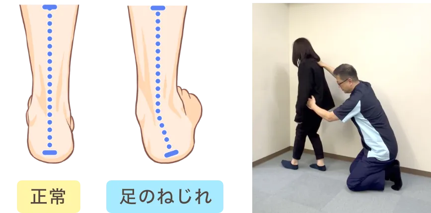 足の捩れ